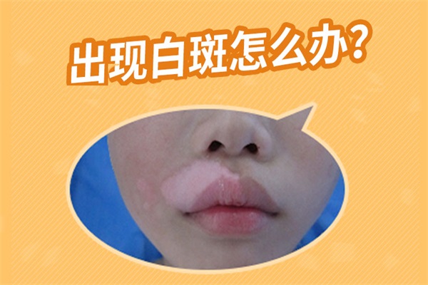 女性白癜風特點,女性白癜風有哪些特點